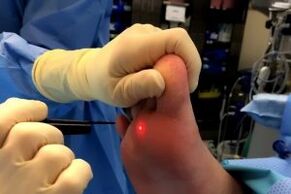 Surgical methods to eliminate warts