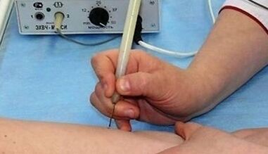 How to get rid of papillomas on the body
