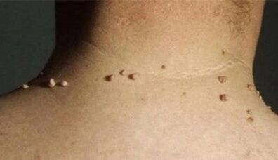 The reasons for the appearance of papillomas on the human body