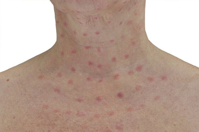 The skin after electrocoagulation