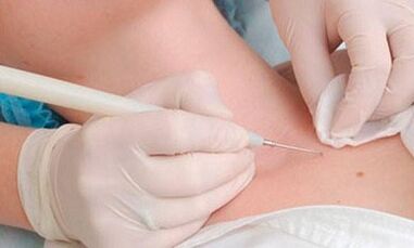 Papilloma elimination methods on the neck