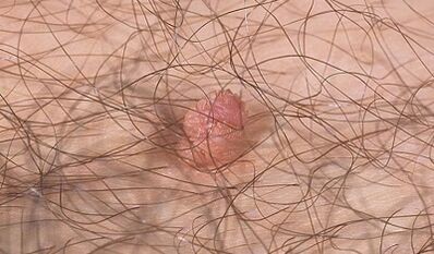 Ways to transfer the human papilloma virus