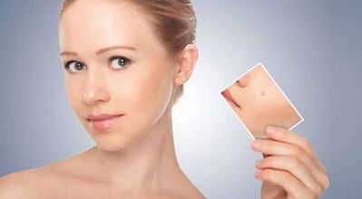 review of effective remedies for warts and papillomas