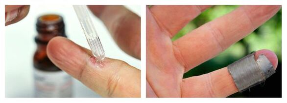 Chemical methods to treat warts