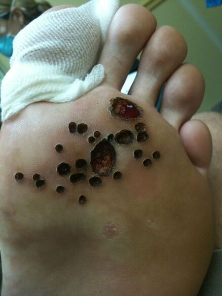 Skin after removing the wart lasers on the leg