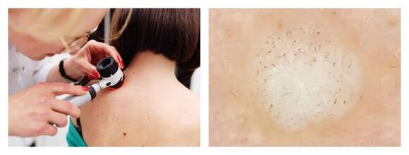 Wart dermatoscopy