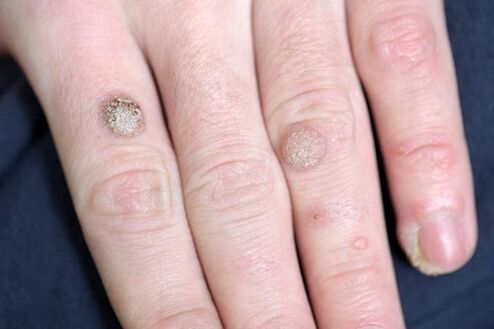 Warts on the arm