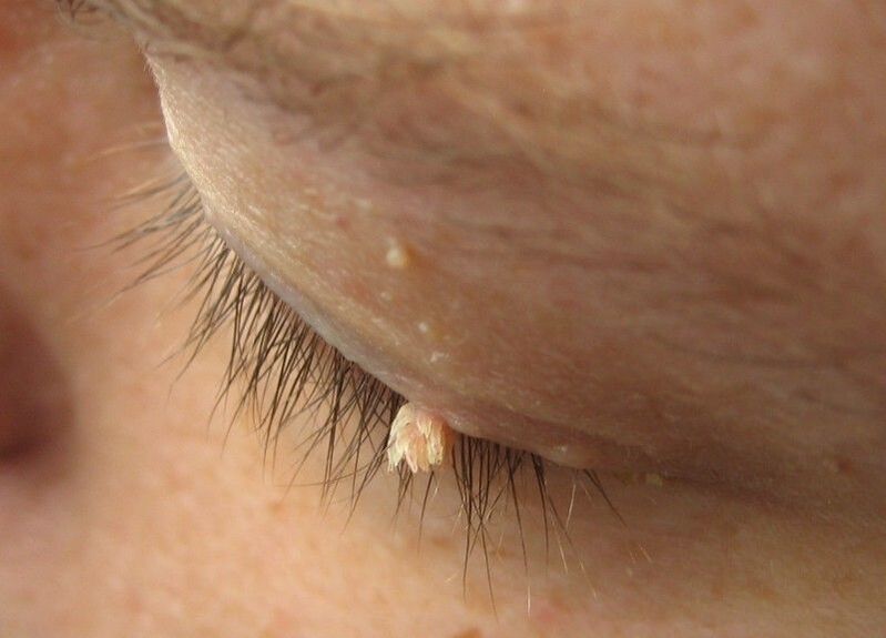 Warts before our eyes