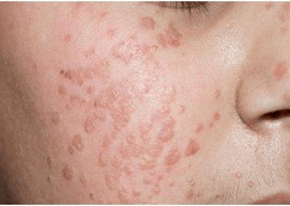 Warts for young people